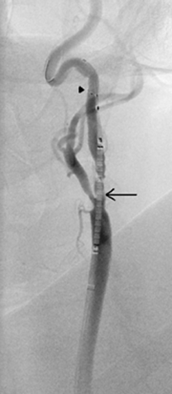 An intra-procedural angiogram of a patient