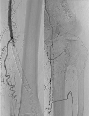 The angiographic findings of SFA stent