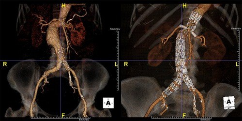 Aortic Surgery