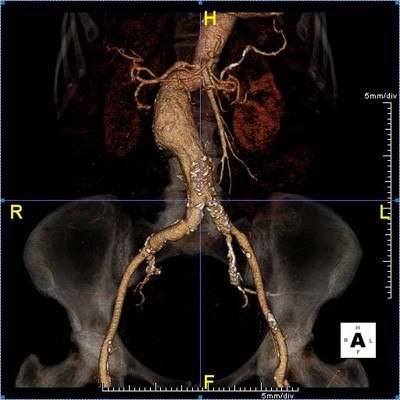 Minimally Invasive Aortic Surgery