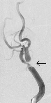 Angiogram of the right carotid artery