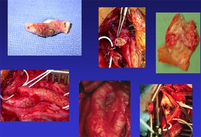 Carotid Artery