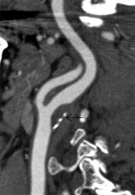 CT scan appearance of a smooth plaque