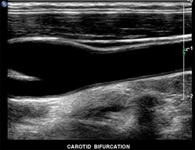healthy carotid artery on ultrasound