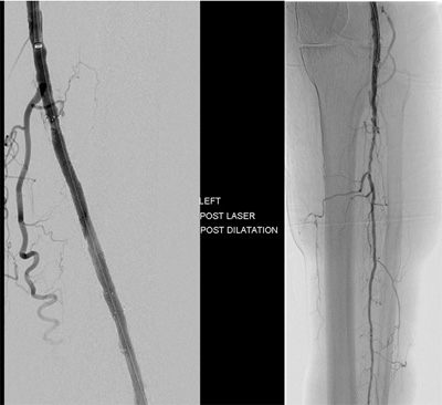 Demonstrates the completion angiogram