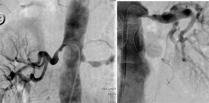 Angiographic appearance of severe bilateral renal artery stenosis
