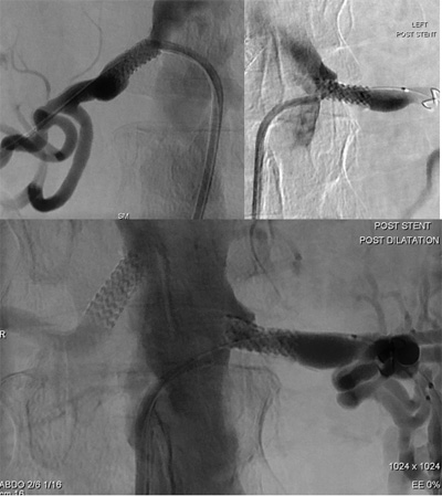 Completion angiographic appearance of the lesions