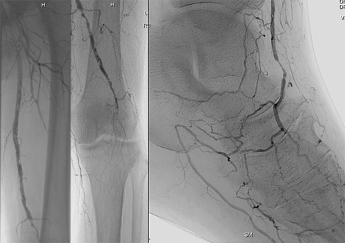 angiogram