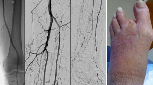 Veins Treatment