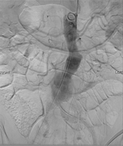 Veins Disorders